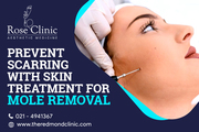 Prevent Scarring With Skin Treatment For Mole Removal