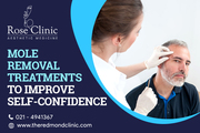 Opt For Mole Removal Treatments To Improve Self-Confidence