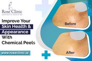 Improve Your Skin Health & Appearance With Chemical Peels
