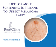 Opt For Mole Screening In Ireland To Detect Melanoma Early