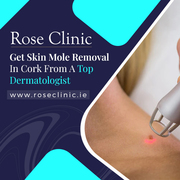 Get Skin Mole Removal In Cork From A Top Dermatologist